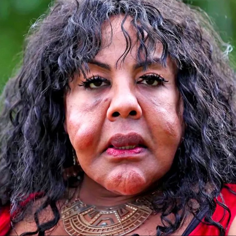 This woman became widely known as “Cement Face” after undergoing black market plastic surgery in the mid-2000s, performed by the notorious “toxic tush doctor” Oneal Ron Morris.