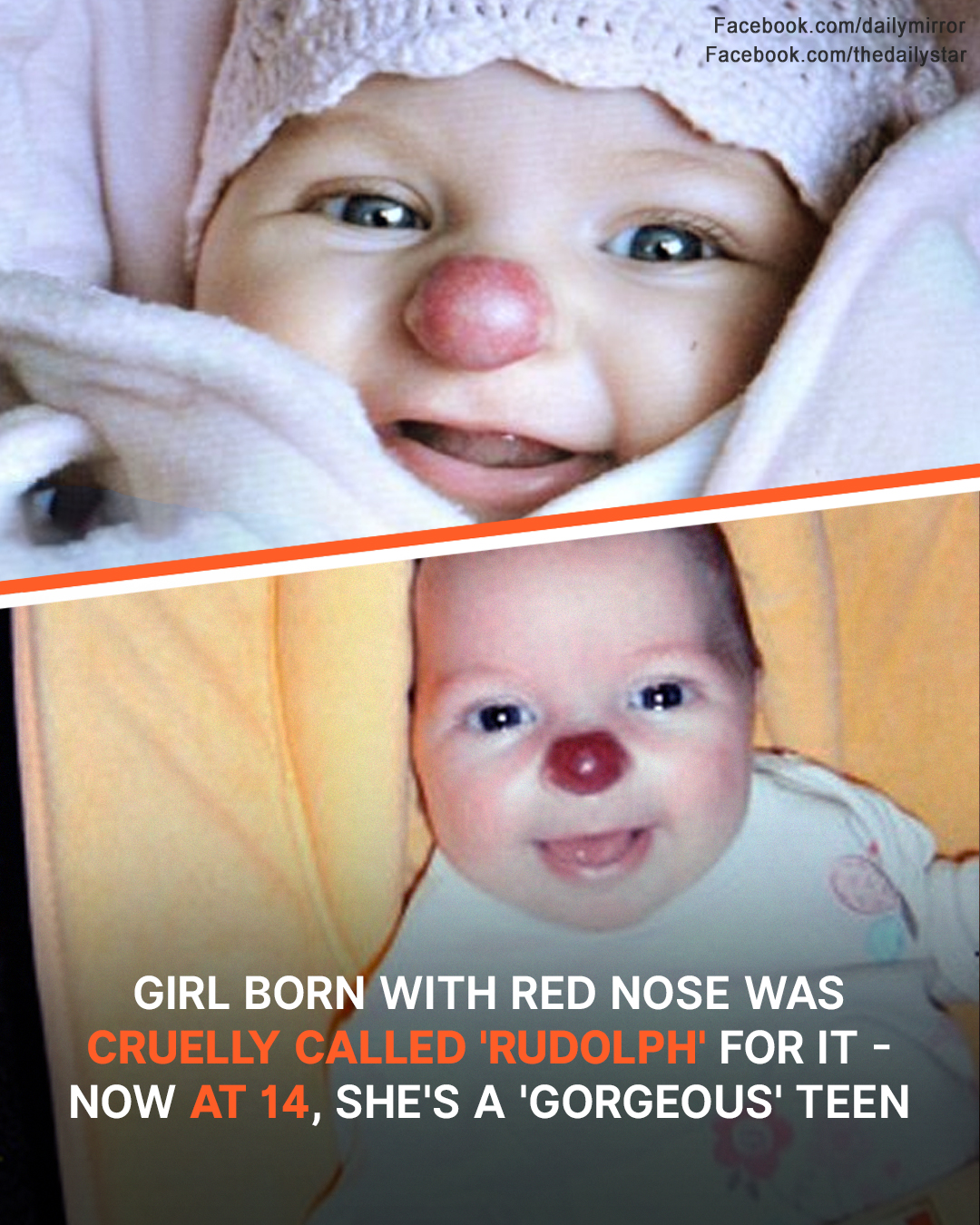 Girl Born with Red Nose Was Cruelly Called ‘Rudolph’ for It – Now at 14, She’s a ‘Gorgeous’ Teen