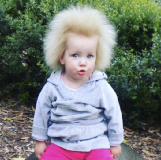 Girl with fuzzy hair embraces her condition