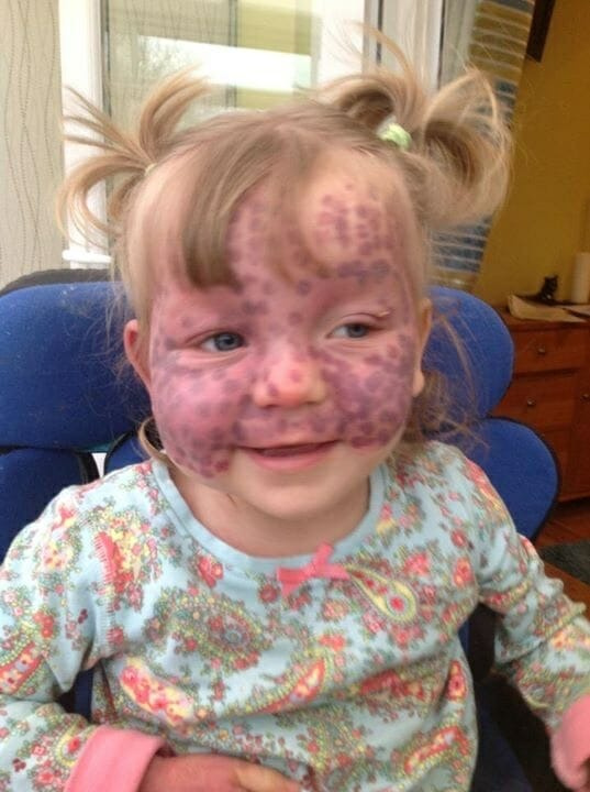 This adorable baby girl was born with “polka dots” all over her. Her parents initially thought they were just bruises, but once they visited the doctor,