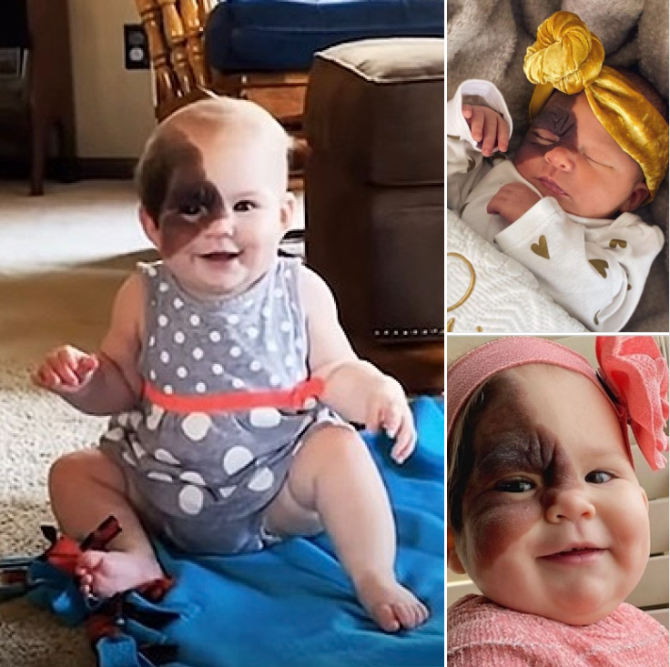 Mom on a mission to show daughter with extremely rare birthmark that she is beautiful